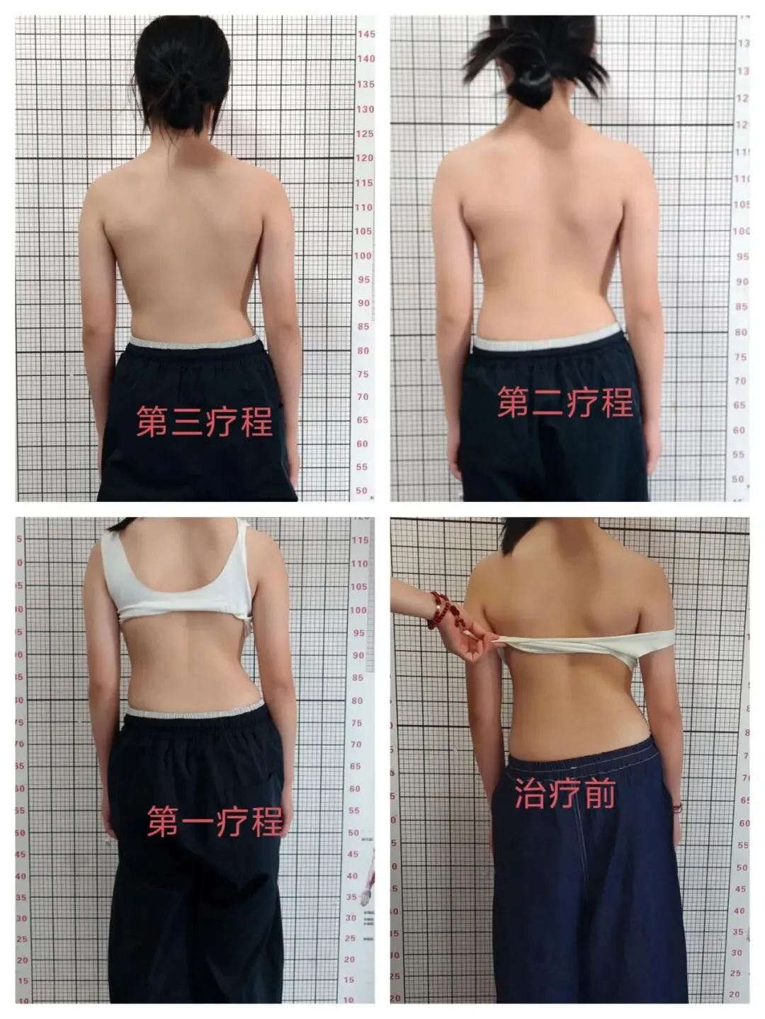 30天科学干预见成效!26°脊柱侧弯改善至14°,见证少年体态蜕变