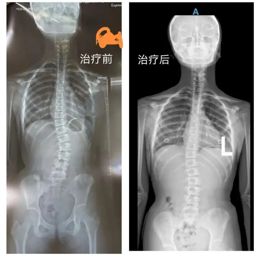 30天科学干预见成效!26°脊柱侧弯改善至14°,见证少年体态蜕变