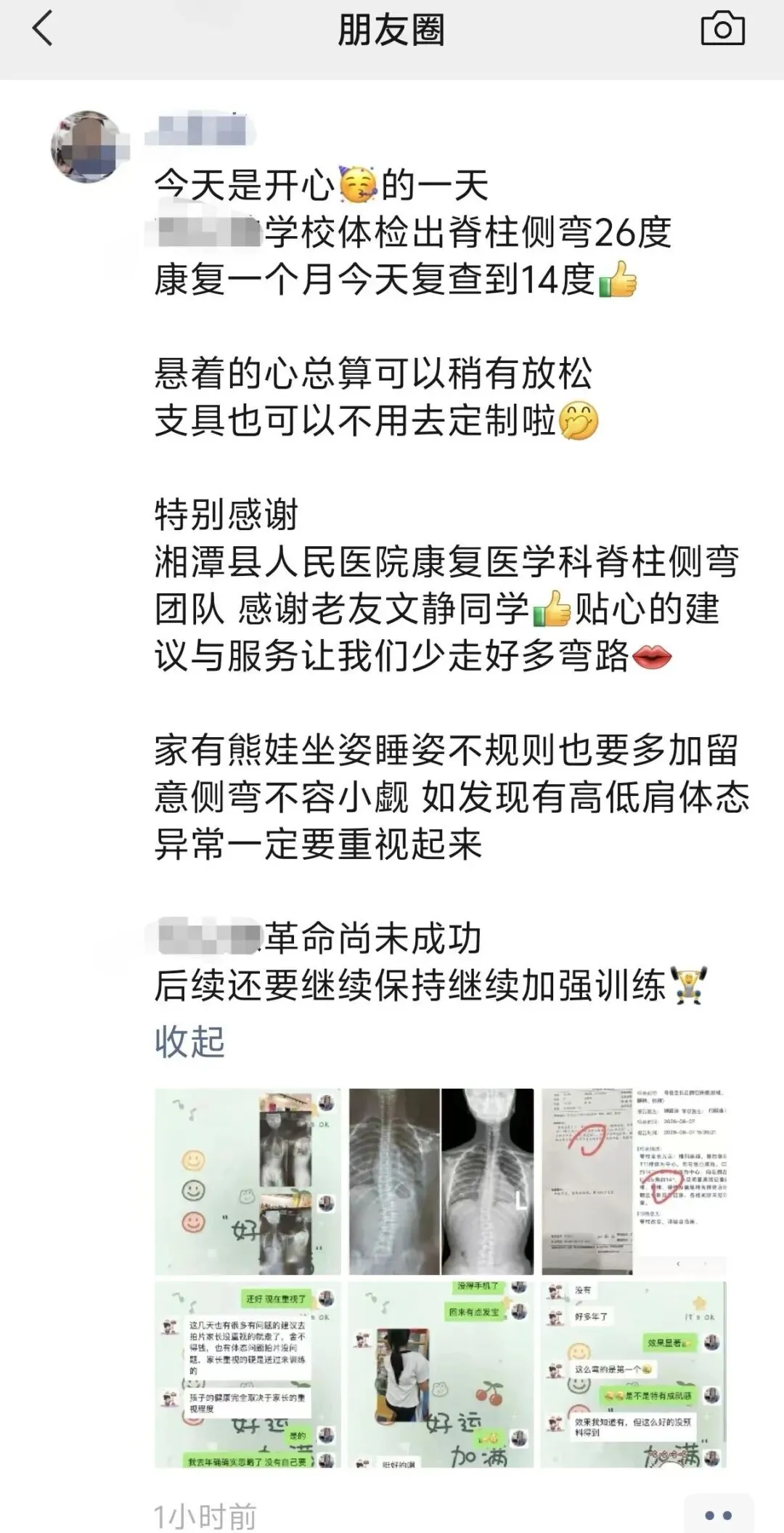 30天科学干预见成效!26°脊柱侧弯改善至14°,见证少年体态蜕变